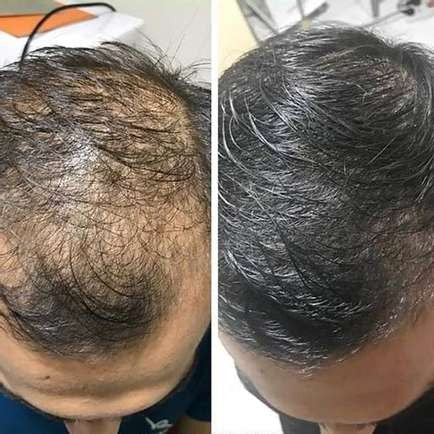 RiceGlow™ — Thicker Hair, Unshakable Confidence | 1+1 Free