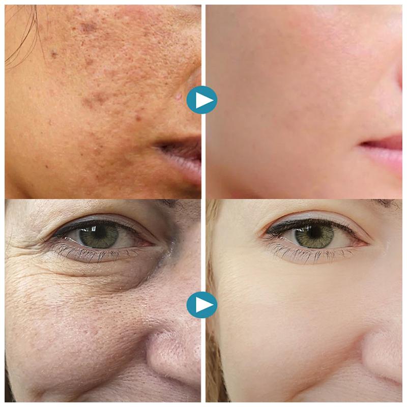 1+1 FREE | PoreGel - Be confident in your own skin again!