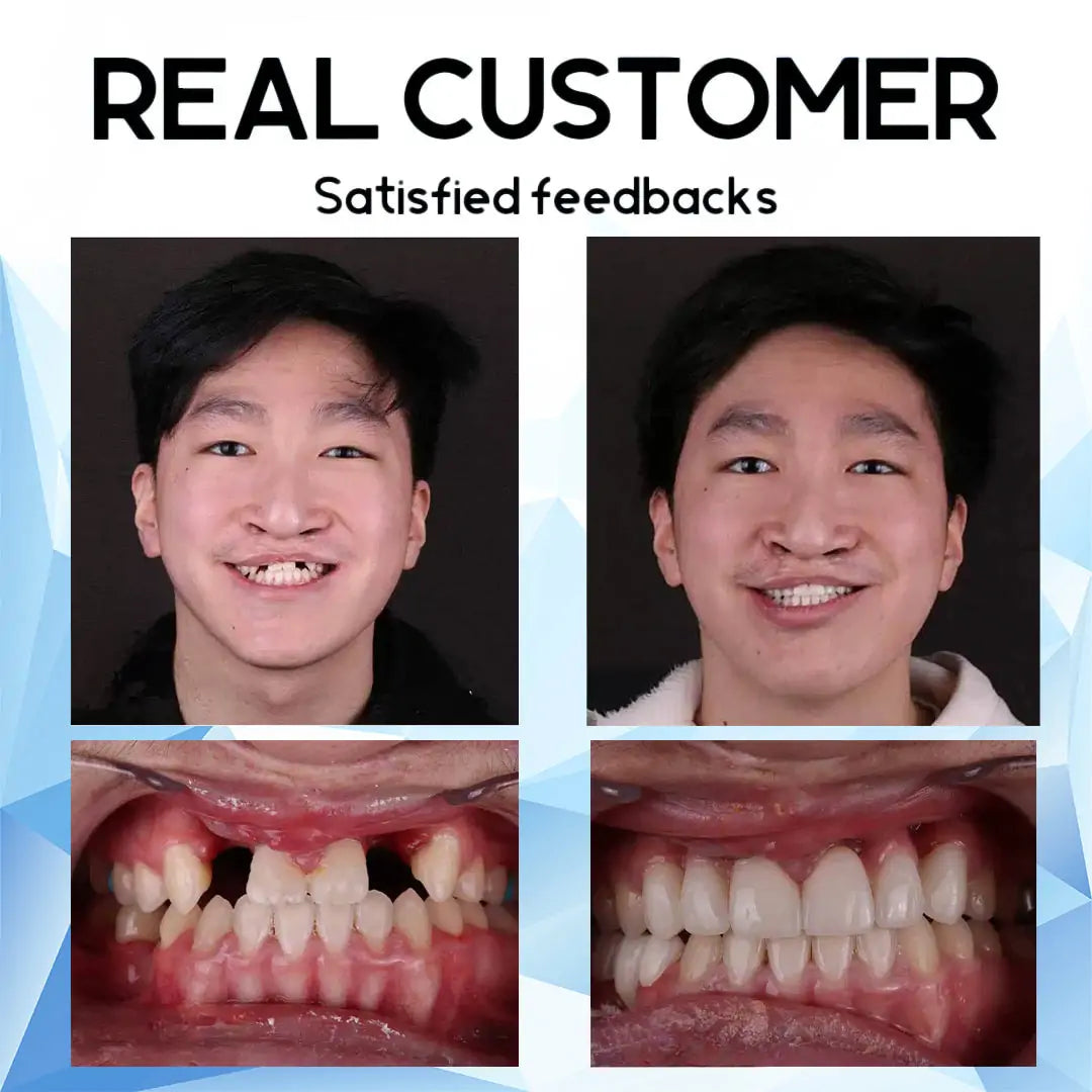 SmilePro – High-quality, Individually Fitted Silicone Denture Set