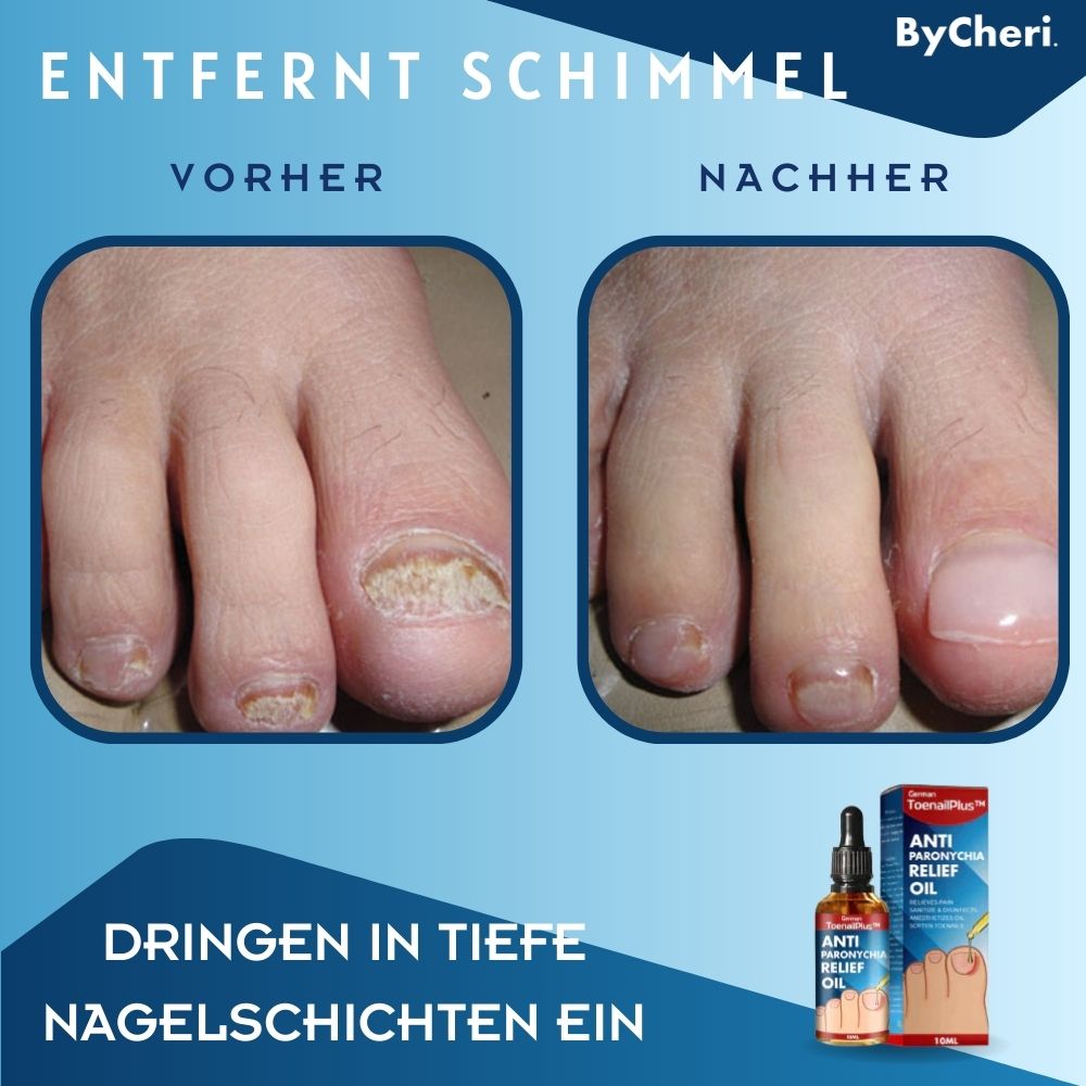 ToePerfect™ - Heals Toe and Finger Nails | Buy 1 Get 1 FREE TEMPORARILY