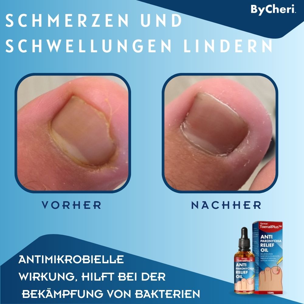 ToePerfect™ - Heals Toe and Finger Nails | Buy 1 Get 1 FREE TEMPORARILY