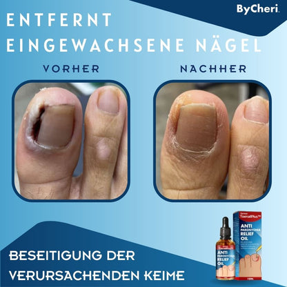 ToePerfect™ - Heals Toe and Finger Nails | Buy 1 Get 1 FREE TEMPORARILY