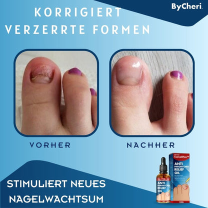 ToePerfect™ - Heals Toe and Finger Nails | Buy 1 Get 1 FREE TEMPORARILY