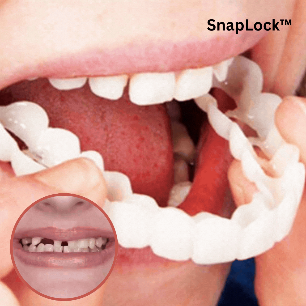 SnapLock Snap-In Dentures (Today Only 50% Off)