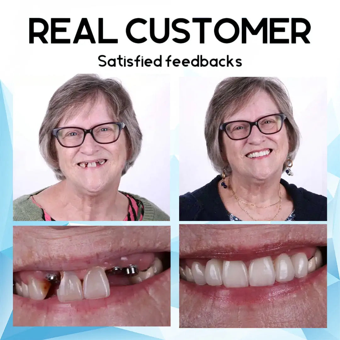 SmilePro – High-quality, Individually Fitted Silicone Denture Set